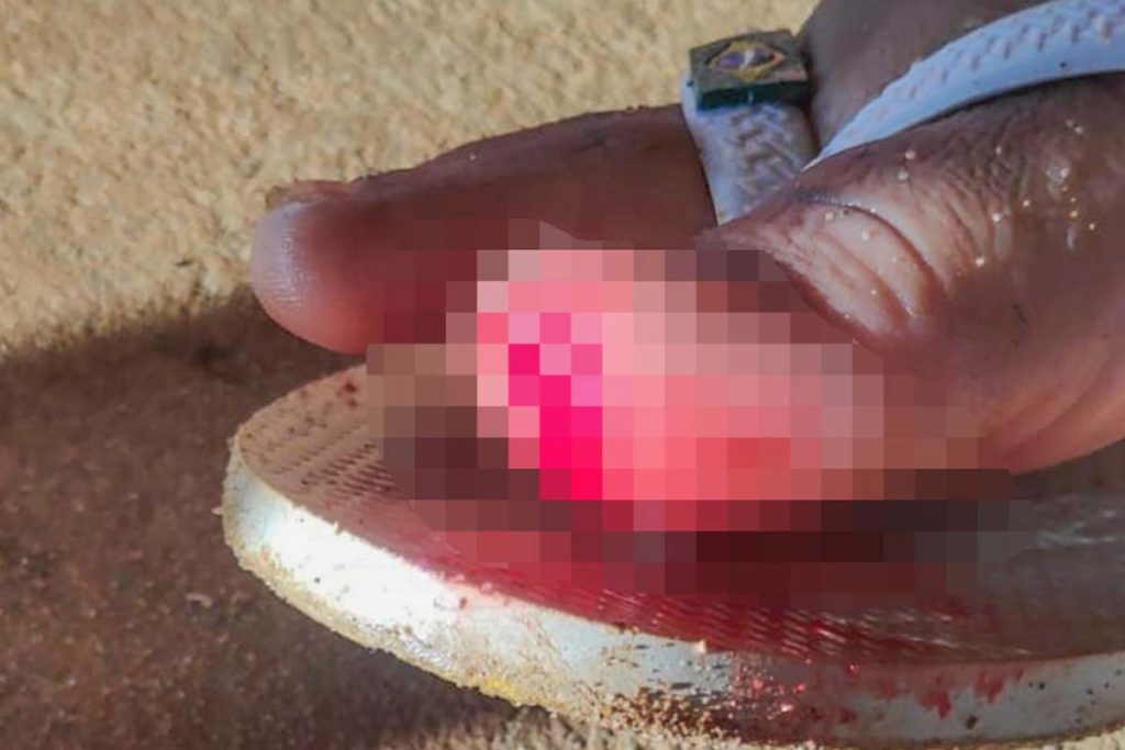 Dezoito ocorrências de atendimentos a vítimas de ataques de piranha e arraias foram registradas pelo Corpo de Bombeiros Militar neste final de semana em Palmas