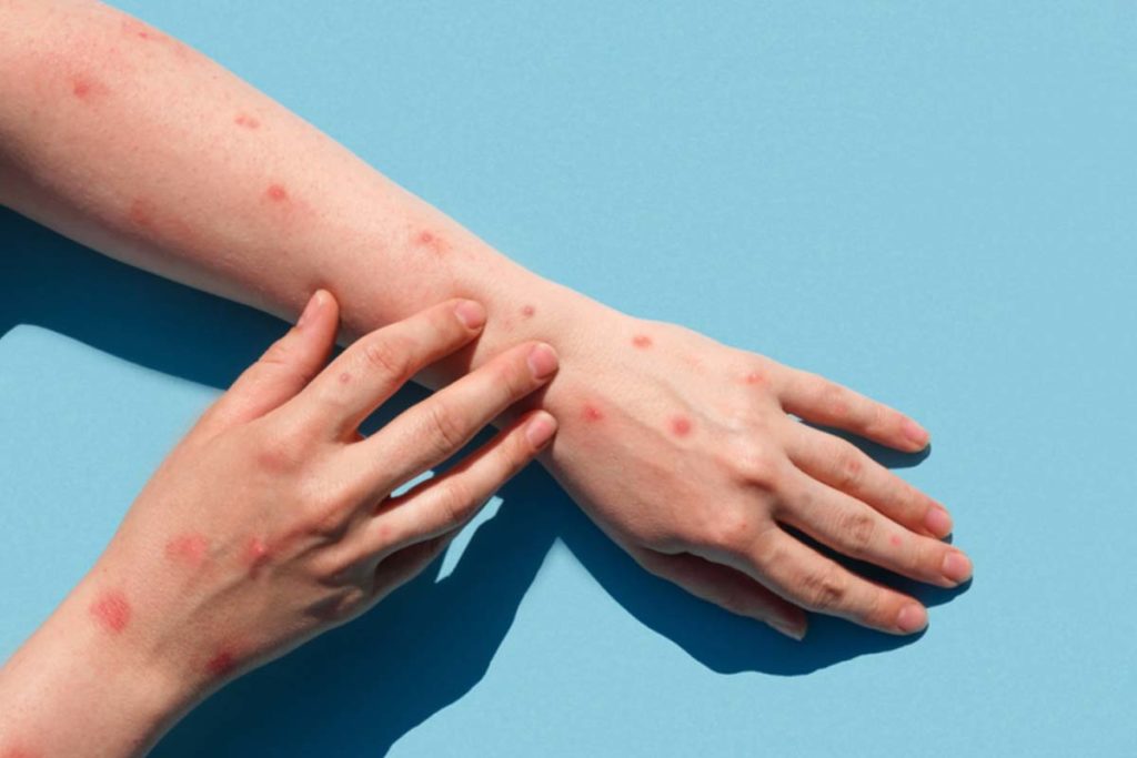 Caso de Monkeypox no Tocantins