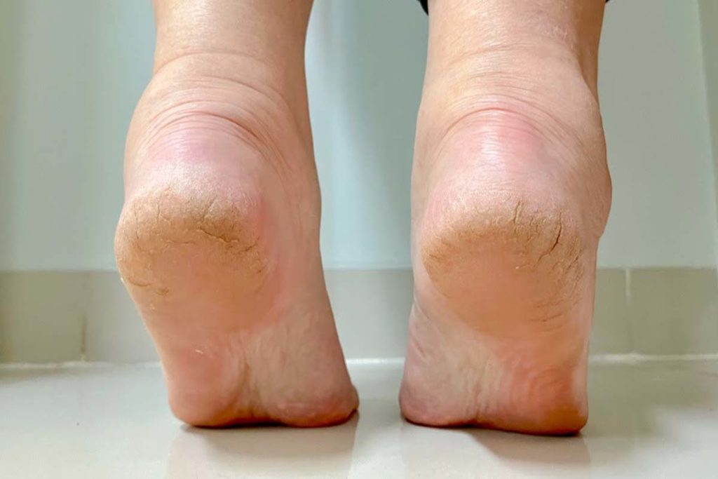 Saiba quais são os cuidados necessários para não sofrer com o tempo seco