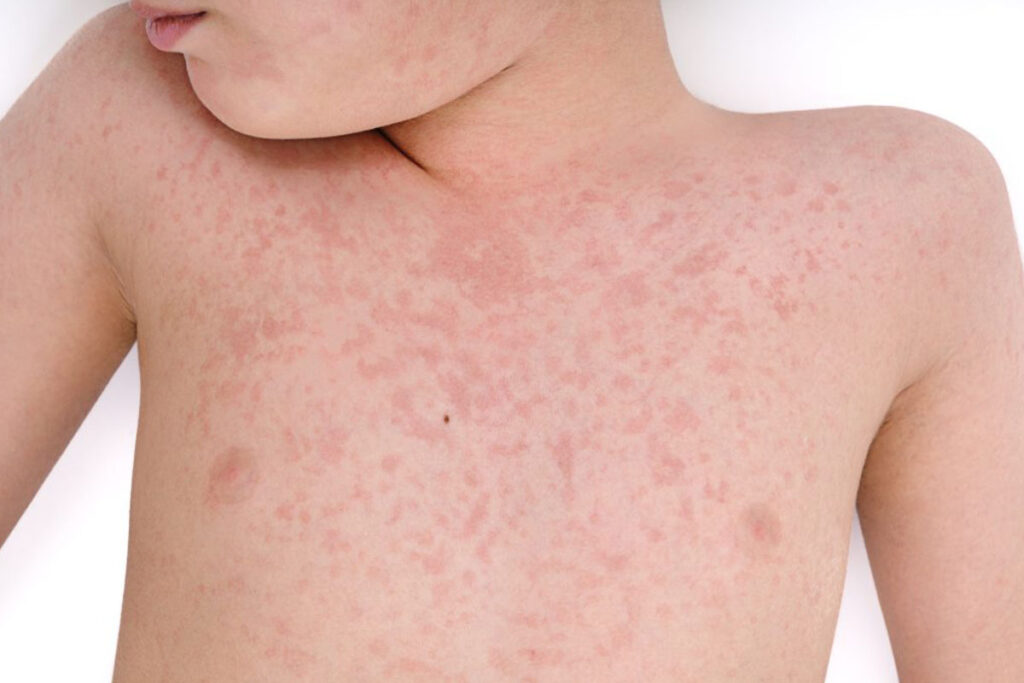 Palmas investiga dois casos suspeitos de sarampo em crianças