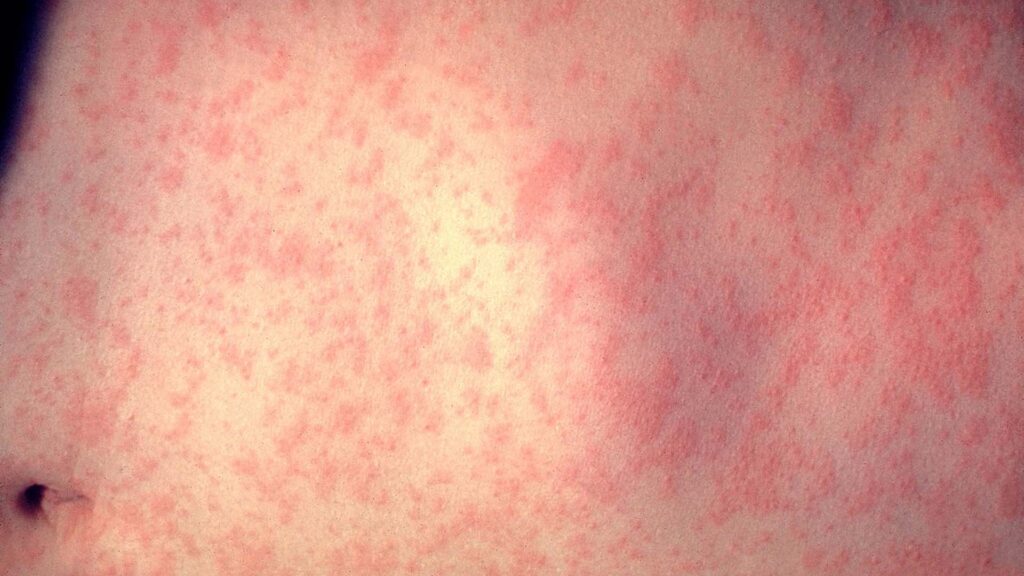 Surto de sarampo em Campos Lindos já soma 16 casos; maioria dos infectados não foi vacinada